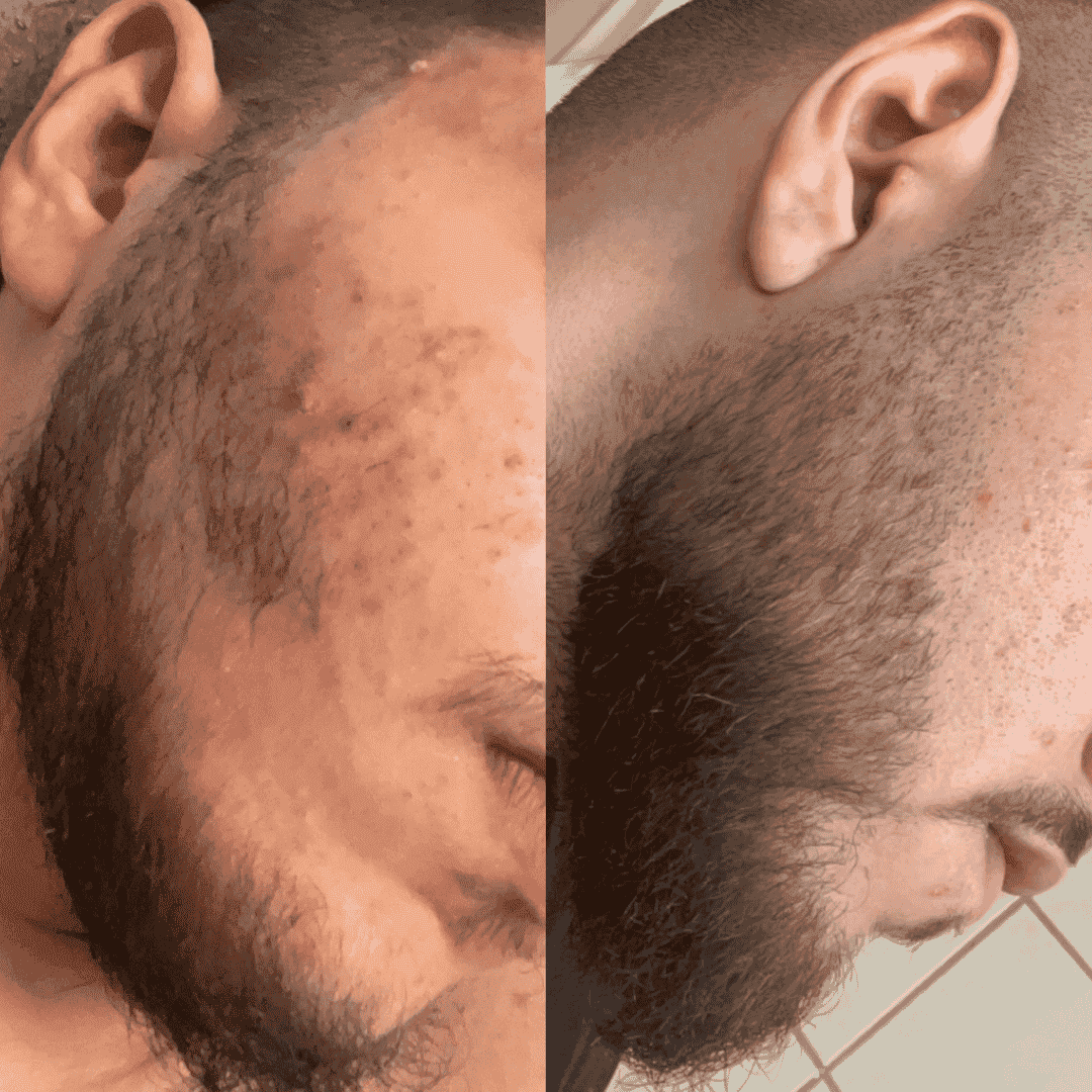 трансформация брада преди след мартин