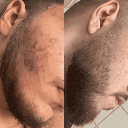 трансформация брада преди след мартин